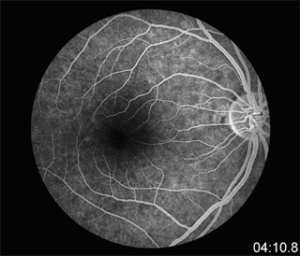 Fundus Florescein Angiography